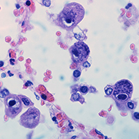https://www.flickr.com/photos/pulmonary_pathology/3791074087/